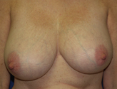 Patient # 57458 Before Photo # 1