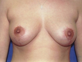 Patient # 73572 After Photo # 2