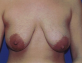 Patient # 73572 Before Photo # 1