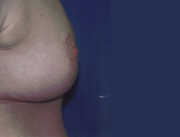Patient # 50207 After Photo # 4