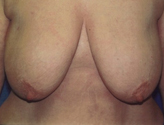 Patient # 50207 Before Photo # 1
