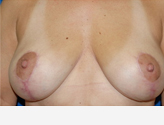 Patient # 57695 After Photo # 2