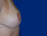 Patient # 57695 After Photo # 4