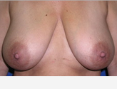 Patient # 57695 Before Photo # 1
