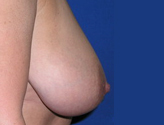 Patient # 57695 Before Photo # 3