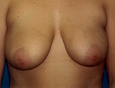 Patient # 77724 After Photo # 2