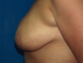Patient # 77724 After Photo # 4