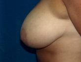 Patient # 77724 Before Photo # 3