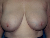 Patient # 19745 Before Photo # 1