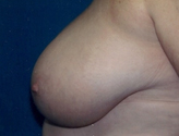Patient # 19745 Before Photo # 3