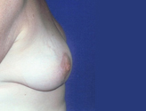 Patient # 83280 After Photo # 2