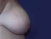 Patient # 83280 Before Photo # 1