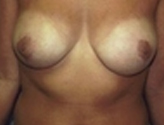 Patient # 19153 After Photo # 2