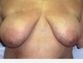 Patient # 19153 Before Photo # 1