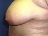 Patient # 19153 Before Photo # 3