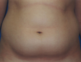 Patient # 38231 Before Photo # 1