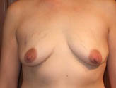 Patient # 70032 Before Photo # 1