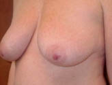 Patient # 29388 Before Photo # 3