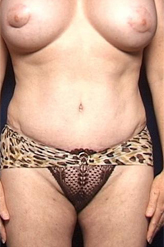 Patient # 63084 After Photo # 2