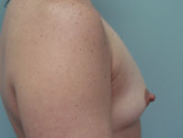 Patient # 79435 Before Photo # 3