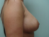Patient # 77528 After Photo # 4