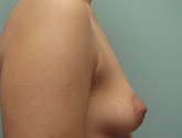 Patient # 77528 Before Photo # 3