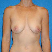 Patient # 86315 Before Photo # 1