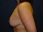Patient # 49312 After Photo # 4