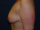 Patient # 49312 Before Photo # 3