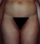 Patient # 97387 After Photo # 2