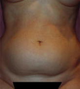Patient # 97387 Before Photo # 1