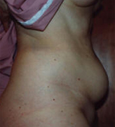Patient # 60108 Before Photo # 1