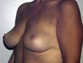 Patient # 53848 After Photo # 4