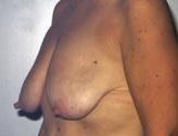 Patient # 53848 Before Photo # 3