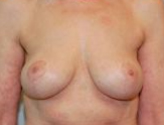 Patient # 72734 After Photo # 2
