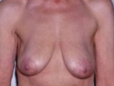 Patient # 72734 Before Photo # 1