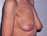 Patient # 72734 Before Photo # 3