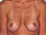 Patient # 46880 After Photo # 2