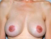 Patient # 94330 After Photo # 2