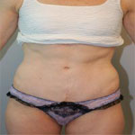 Patient # 48846 After Photo # 2