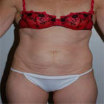 Patient # 48846 Before Photo # 1