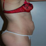 Patient # 48846 Before Photo # 3