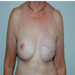 Patient # 79032 After Photo # 2