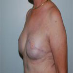 Patient # 79032 After Photo # 4