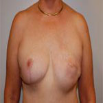 Patient # 79032 Before Photo # 1