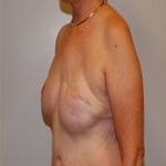 Patient # 79032 Before Photo # 3