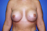 Patient # 22606 After Photo # 2