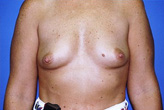 Patient # 22606 Before Photo # 1