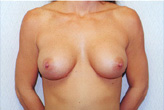 Patient # 91865 After Photo # 2
