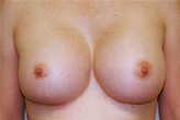Patient # 59934 After Photo # 2